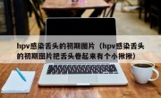 hpv感染舌头的初期图片（hpv感染舌头的初期图片把舌头卷起来有个小揪揪）